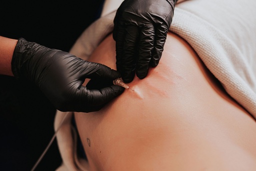 Carboxiterapia